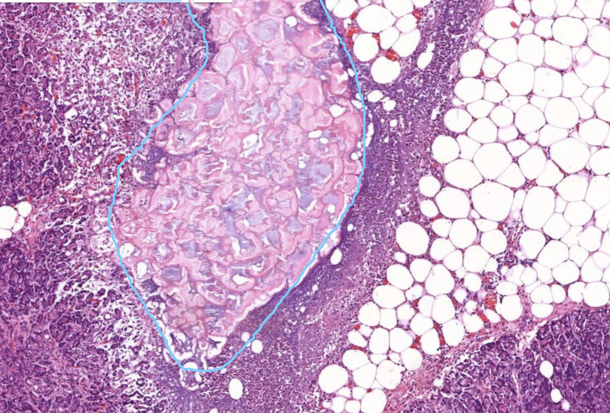 Histopathologisches Bild: Prostatahyperplasie mit knotiger Architektur